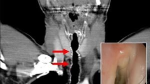 Wiry black hairs grow deep in the back of man’s throat and voice box after decades of smoking