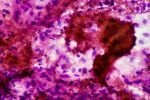 Washington tuberculosis patient who was arrested for refusing treatment is cured