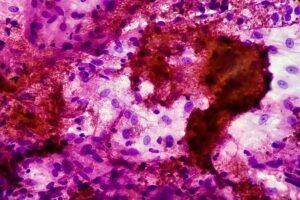 Washington tuberculosis patient who was arrested for refusing treatment is cured