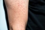 Measles cases in the U.S. are already triple last year’s total