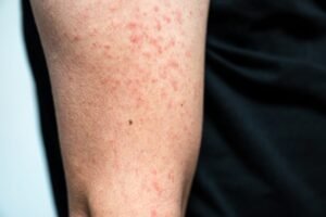 Measles cases in the U.S. are already triple last year’s total