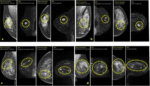 AI increases breast MRI’s cancer detection four-fold