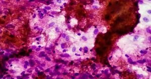 Washington tuberculosis patient who was arrested for refusing treatment is cured