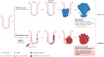 Western lifestyle, metaflammation and the cell of origin of colon cancer