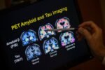 Groundbreaking blood test could hold key to diagnosing Alzheimer’s
