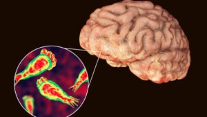 10-year-old hospitalized with suspected ‘brain-eating’ amoeba