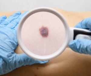 Beware of Unusual Signs of Melanoma