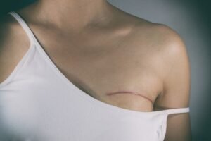 Double Mastectomy Doesn’t Increase Breast Cancer Survival: Study