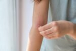 Study suggests limiting oral corticosteroid use to 90 days reduces adverse effects in atopic dermatitis patients
