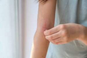 Study suggests limiting oral corticosteroid use to 90 days reduces adverse effects in atopic dermatitis patients