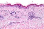 Primary Cause of Lupus Discovered–and A Possible Way to Reverse It