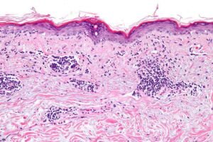 Primary Cause of Lupus Discovered–and A Possible Way to Reverse It