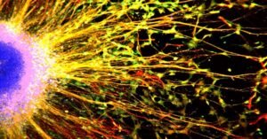 Cancer Drug Could Ease Cognitive Function for Some With Autism