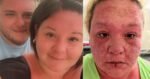 I was on my dream Caribbean holiday – then my skin started falling off | UK News
