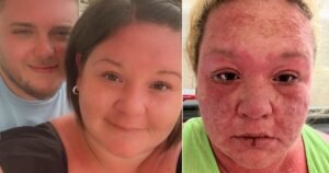 I was on my dream Caribbean holiday – then my skin started falling off | UK News