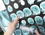 Gene variant predicts cognitive decline after stroke