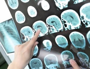 Gene variant predicts cognitive decline after stroke Gene variant predicts cognitive decline after stroke