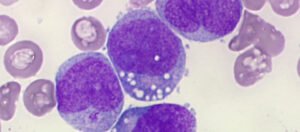 Fighting Leukaemia By Targeting Its Stem Cells