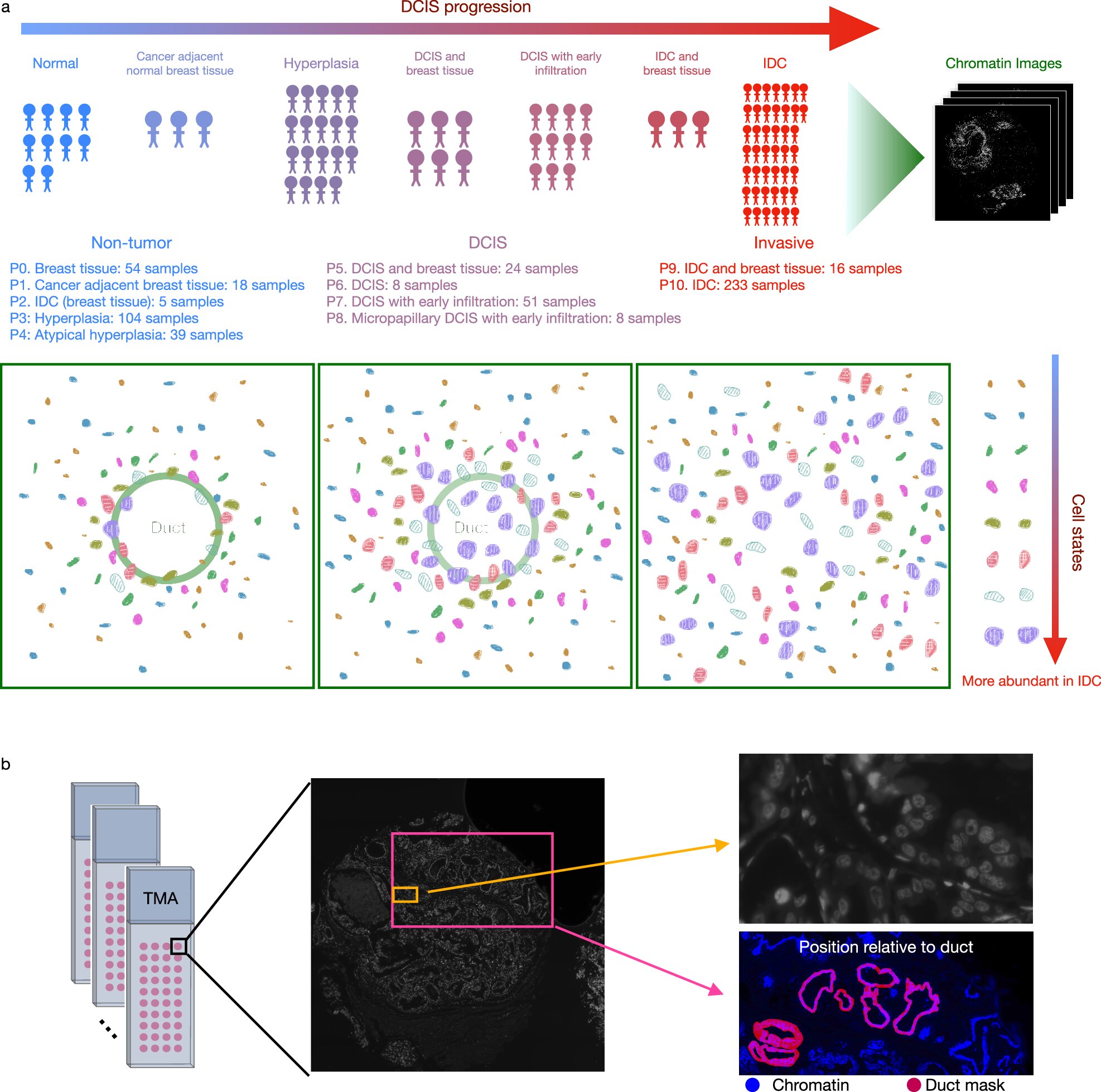 AI model identifies certain breast tumor stages likely to progress to invasive cancer