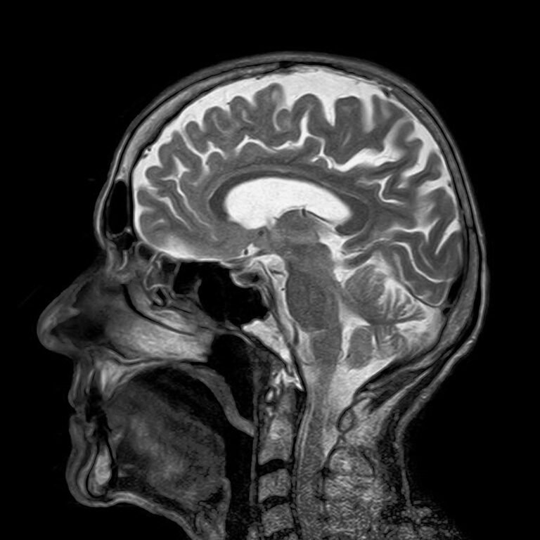 Study explores machine learning for classifying functional neurological disorder