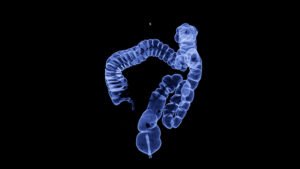 Eliminating Racial Disparities in Colorectal Cancer Screening