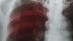 Pierce County woman who refused treatment for her tuberculosis now fully cured Pierce County woman who refused treatment for her tuberculosis now fully cured