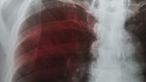 Pierce County woman who refused treatment for her tuberculosis now fully cured Pierce County woman who refused treatment for her tuberculosis now fully cured