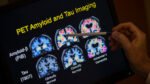 Blood tests for Alzheimer’s may be coming to your doctor’s office. Here’s what to know