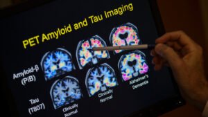 Blood tests for Alzheimer’s may be coming to your doctor’s office. Here’s what to know
