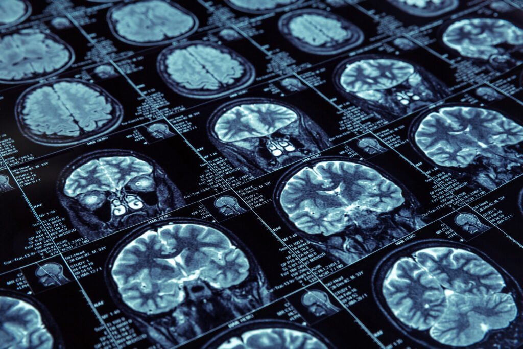 Data from largest clinical trial of pre-symptomatic Alzheimer’s disease now widely available