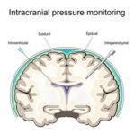 New Research Identifies Less Invasive Method for Examining Brain Activity Following Traumatic Brain Injury New Research Identifies Less Invasive Method for Examining Brain Activity Following Traumatic Brain Injury