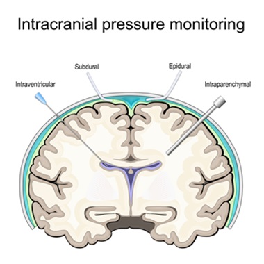 New Research Identifies Less Invasive Method for Examining Brain Activity Following Traumatic Brain Injury