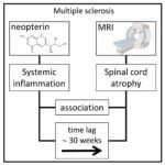 Multiple sclerosis progression linked to immune response outside the brain