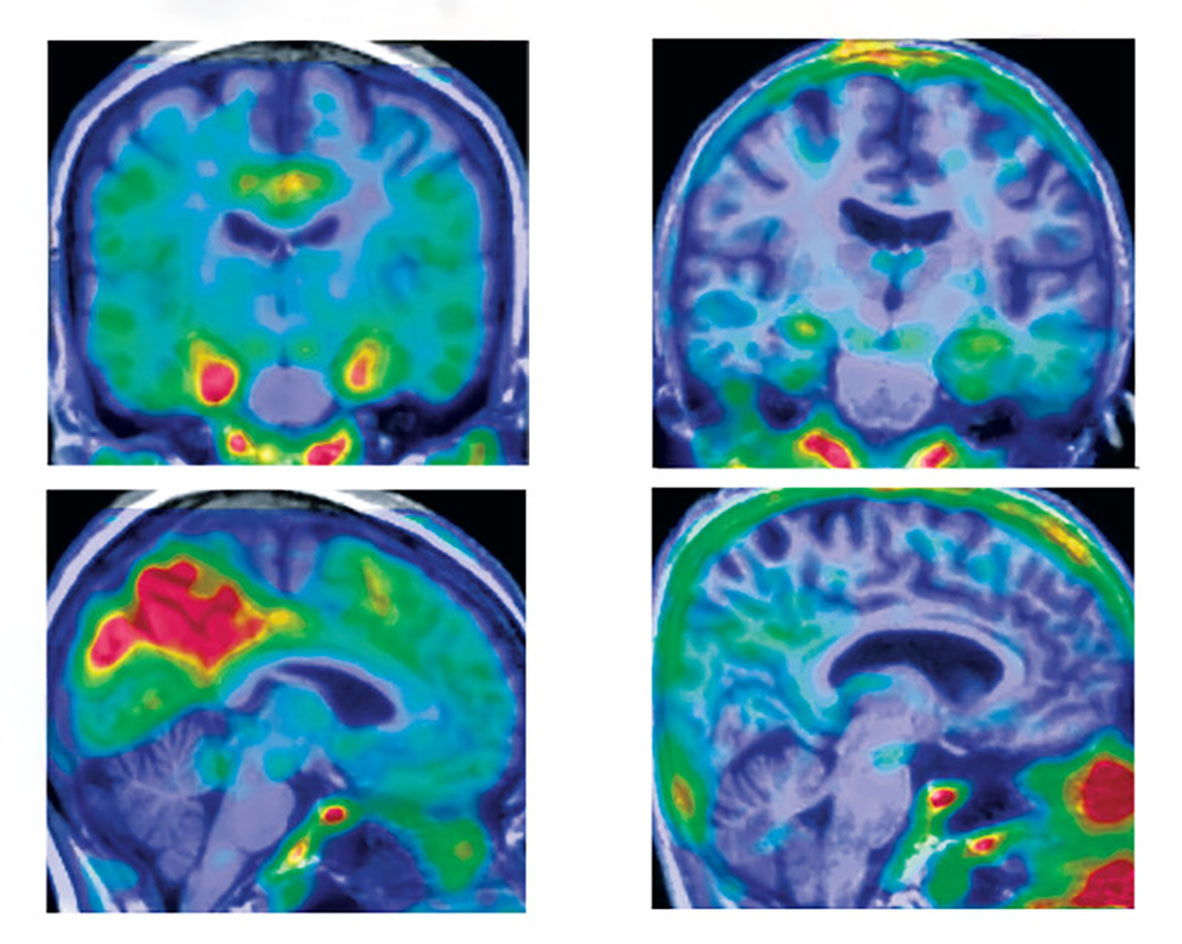 Gene variant slows form of inherited Alzheimer’s disease